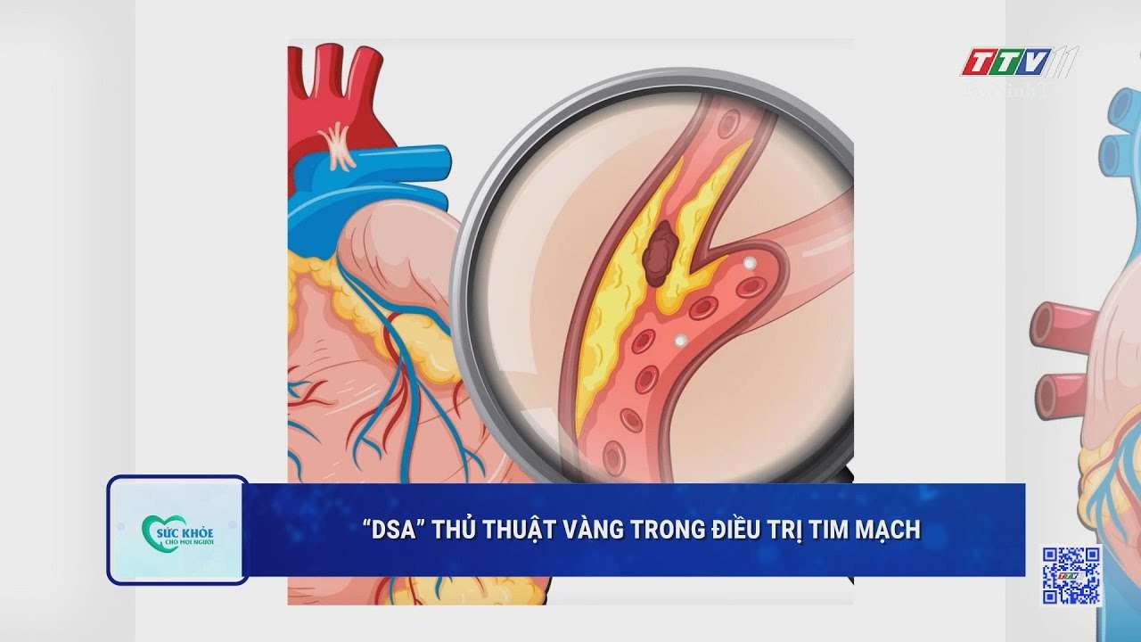 “DSA” thủ thuật vàng trong điều trị tim mạch